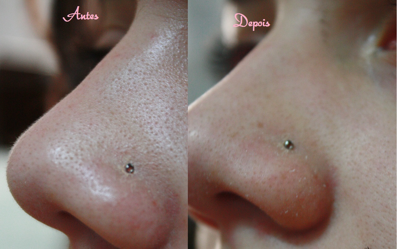 Facial for black heads Ride