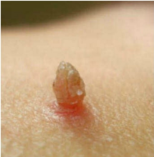 Genital Warts - Terrasil Wart Removal Ointment